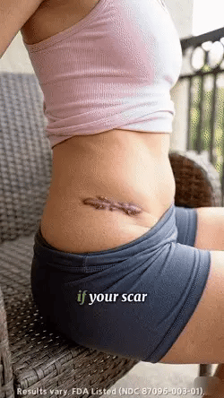 Silicone Scar Removal Gel – Advanced Scar Care Treatment 20g